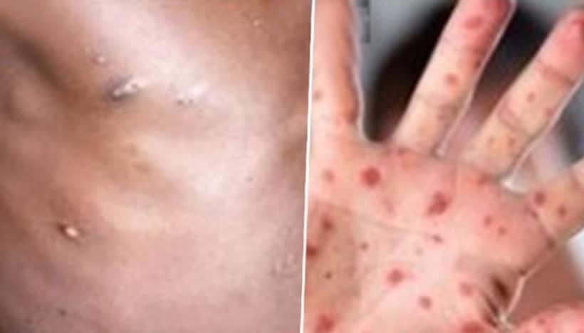 How is Tomato Flu different from Monkeypox? Know symptoms, treatment, and precautions here