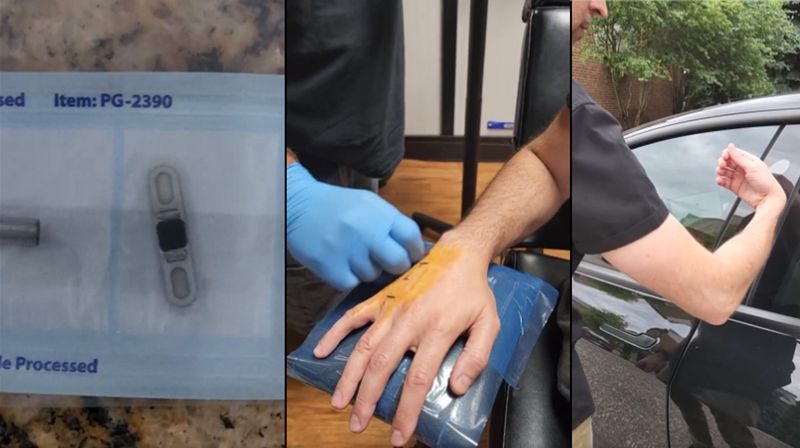 Tesla Owner Implants Tiny Chip Into His Hand To Unlock The Car