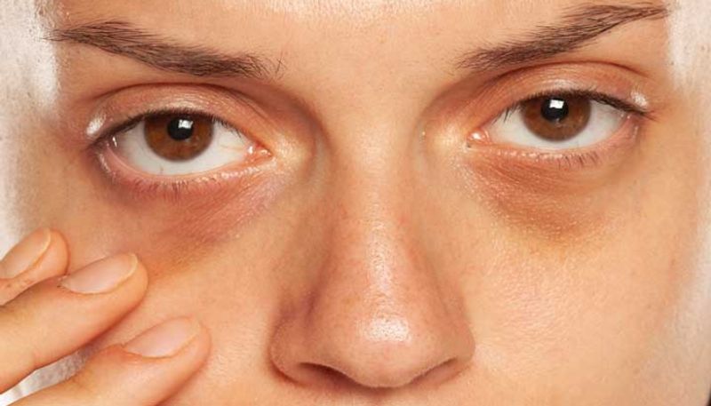 home remedies to remove Dark circles under the eyes