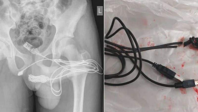 Teen gets USB cable stuck in genitals