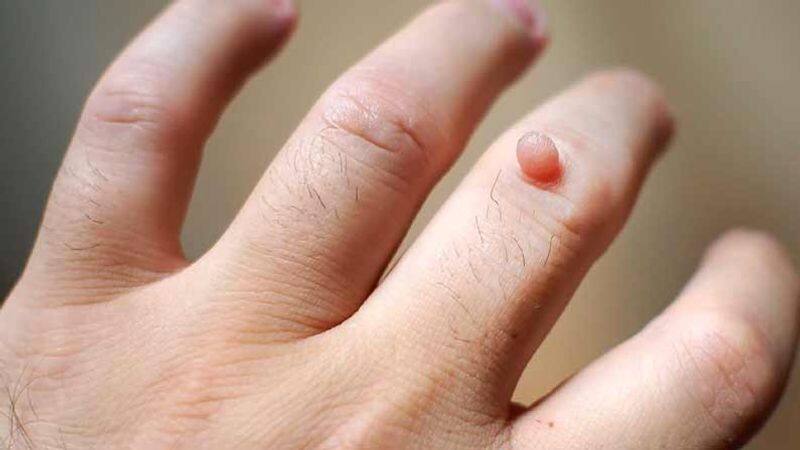 home remedies for Warts in tamil 