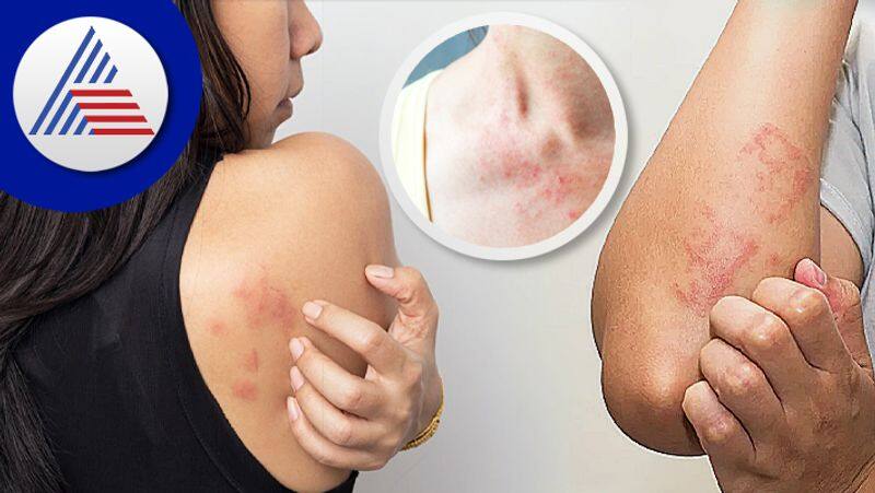 summer skin care tips best home remedies to get rid of skin allergy in summer in tamil mks