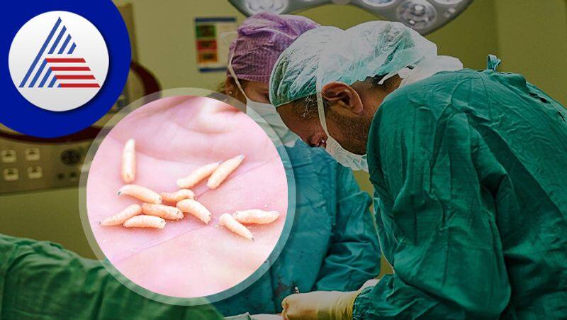 145 Maggots Removed From Womans Eyes And Nose In Bangalore Vin