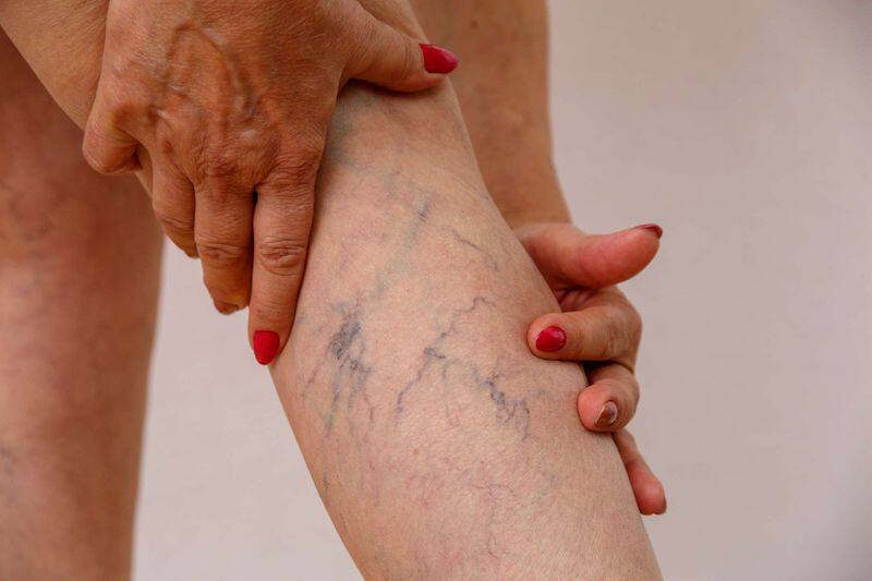 varicose veins causes symptoms and treatment in tamil mks