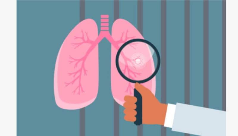 simple urine test detect lung cancer early study 