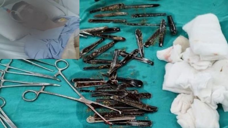 63 Steel Spoons Removed From Man's Stomach In UP