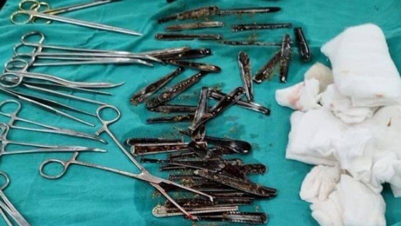 63 Steel Spoons Removed From Man's Stomach In UP