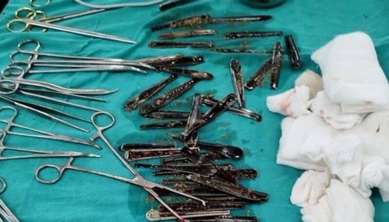 doctors removed 63 spoons from youths stomach 