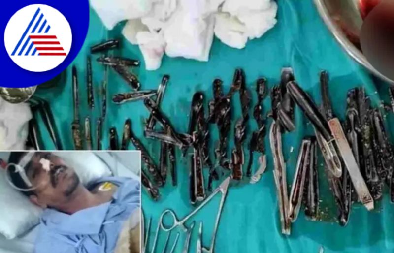 Doctors Remove 63 Spoons From Muzaffarnagar Mans Stomach Vin