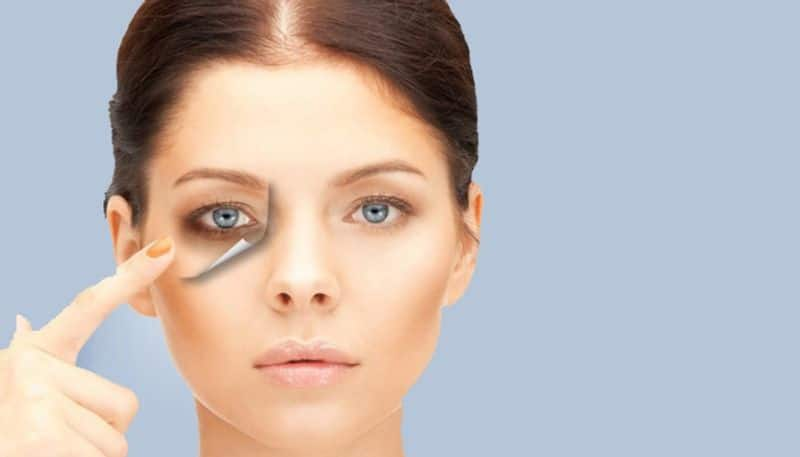 home remedies to get rid of dark circles under eyes