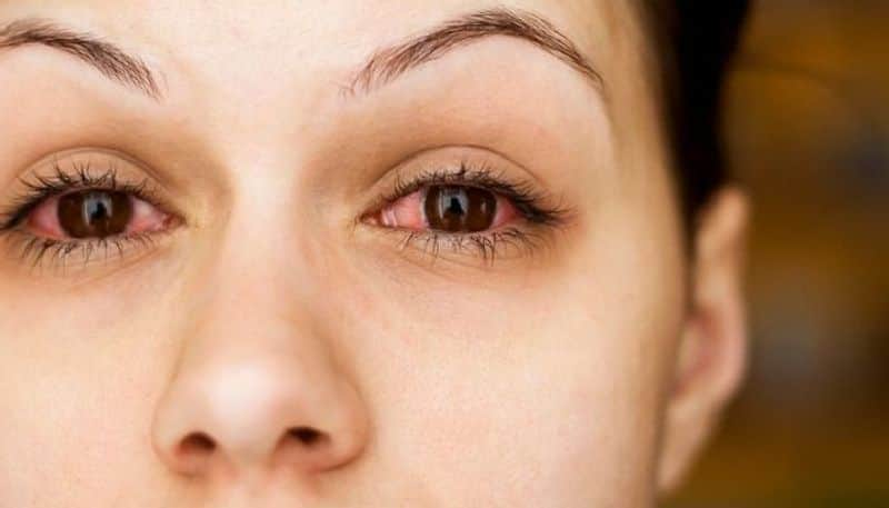 Eye Care Tips: causes of red eye and other infections in winter rsl