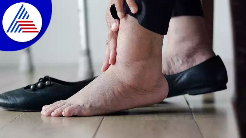 Feet Get Swollen When You Sit For Long Hours, Here Are Possible Causes Vin