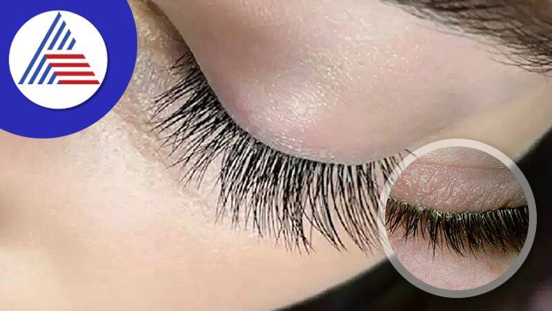 Home remedies of dandruff in eyelashes