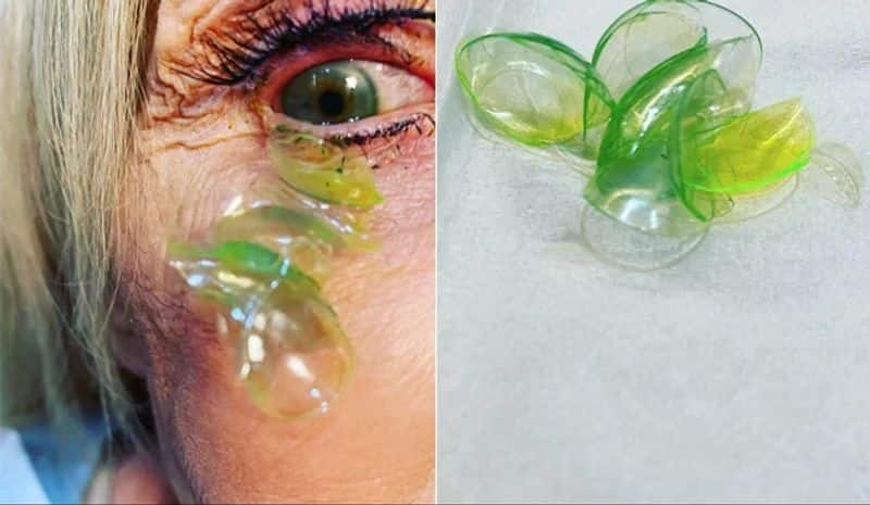 Shocking Video !! Doctor has removed 23 Contact Lenses From Patient's eye..