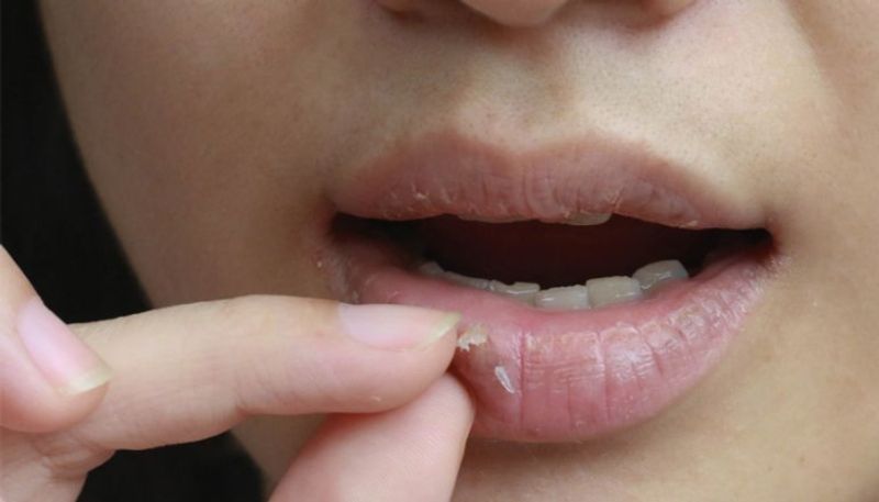 common reasons behind chapped lips