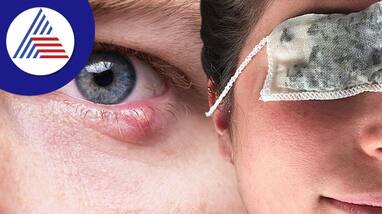 Home remedies for Pink Eyes Home remedies for Pink Eyes