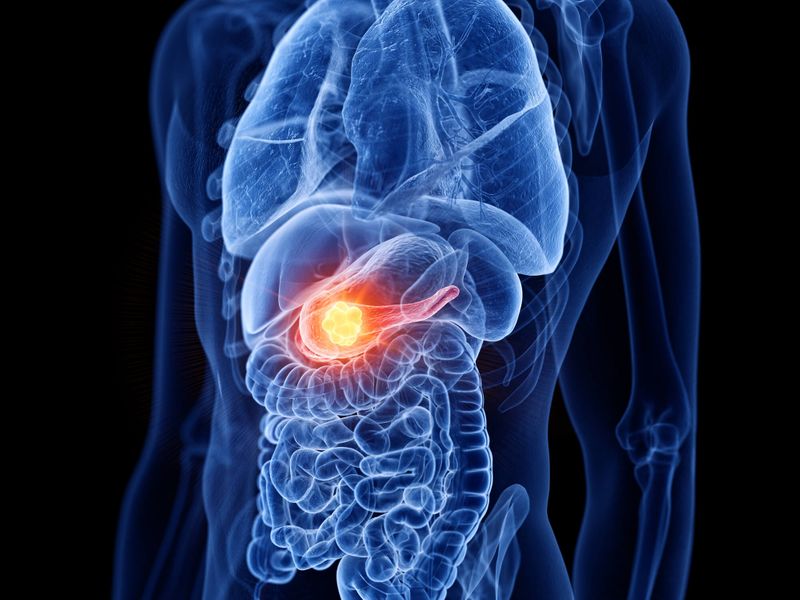 Paediatric Pancreatic Cancer: Signs and risk factors to watch out for RBA