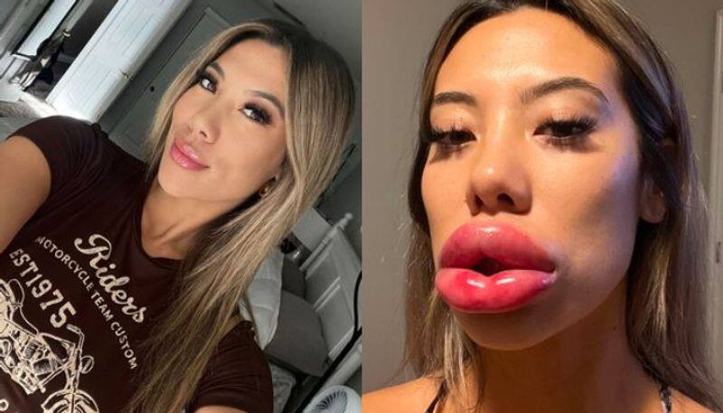 Womans lips balloon to over triple their size after  lip filler