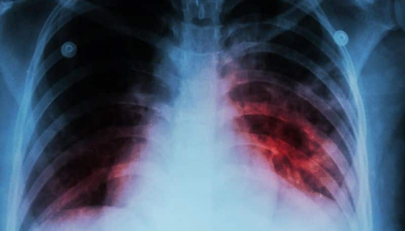 Affects the reproductive organs expert says that tuberculosis is a threat