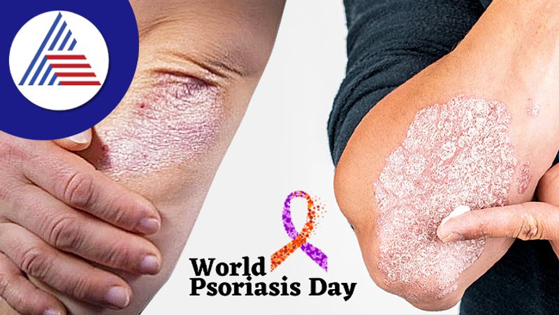 World Psoriasis Day, Know How This Skin Disease Is Linked To Mental Health Vin