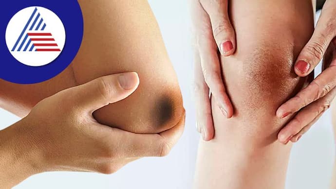 Here are some simple home remedies to get rid of dark elbows and knees