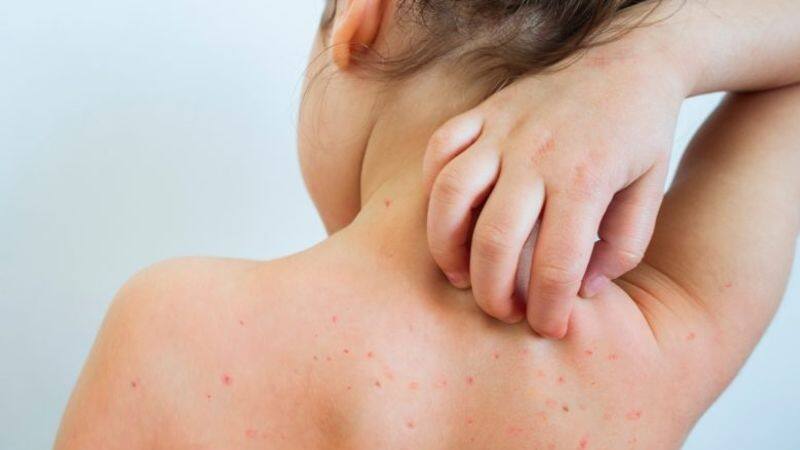 measles
