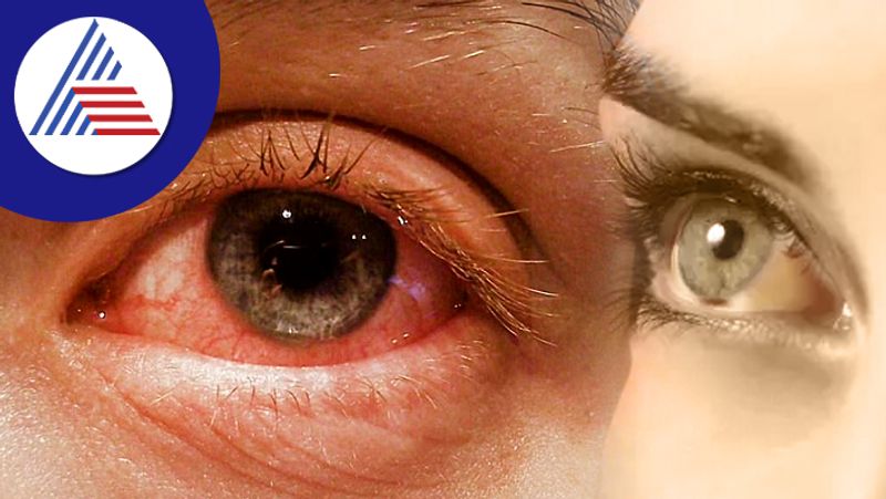 Madras Eye infection found in Udupi gow