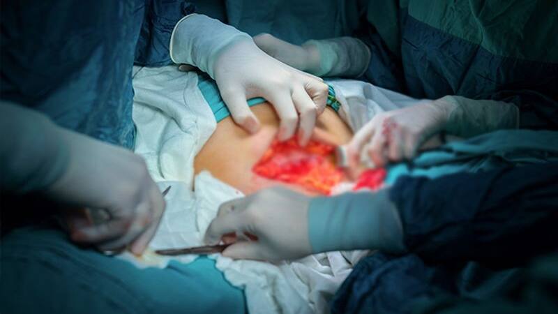 heart transplant
