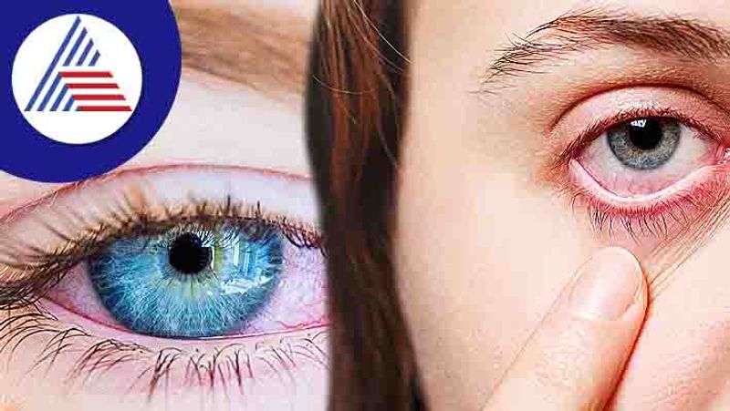 Here are home remedies to treat pink eyes