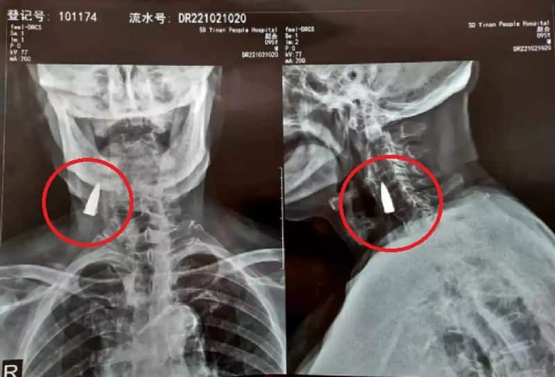 xray revealed a bullet lodged in mans neck for nearly eighty years at china