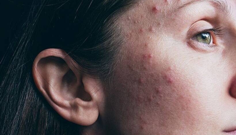 Google Lens will help you in detecting rashes, skin conditions and more; Here's how it works