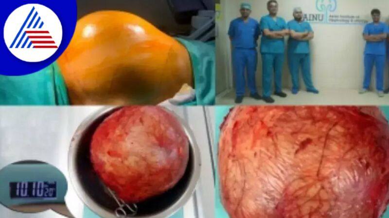 Hyderabad Doctors Remove Football Sized Kidney Tumour From Patient Vin