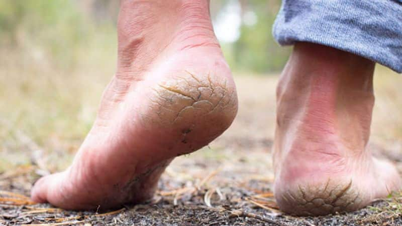 easy remedies to get rid of cracked heels rsl