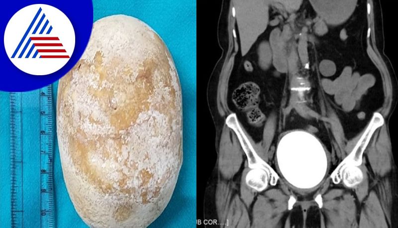 Doctors from Manipal removed the worlds largest kidney stone from a womans body gvd