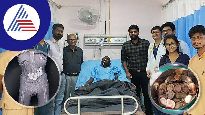 The doctor removed 187 coins from the old mans stomach at bagalkote rav