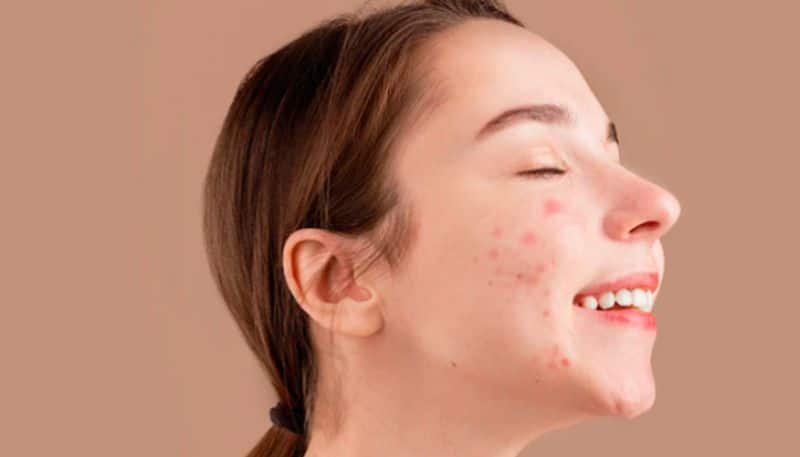 5 face packs to get rid of acne spots azn 