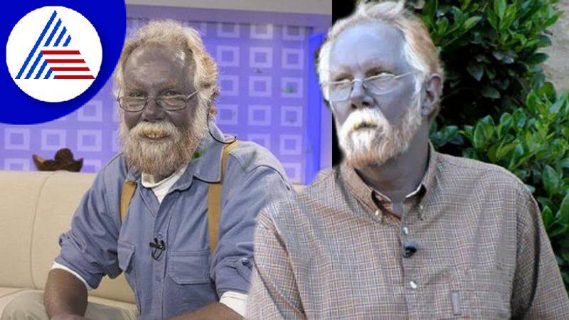 Mans Skin Turns Blue After Taking Dietary Supplements For A Decade Vin