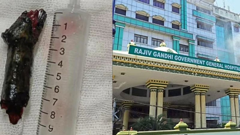 Chennai Rajiv Gandhi Government Hospital doctors remove 10-cm-long wood lodged behind man eyeball