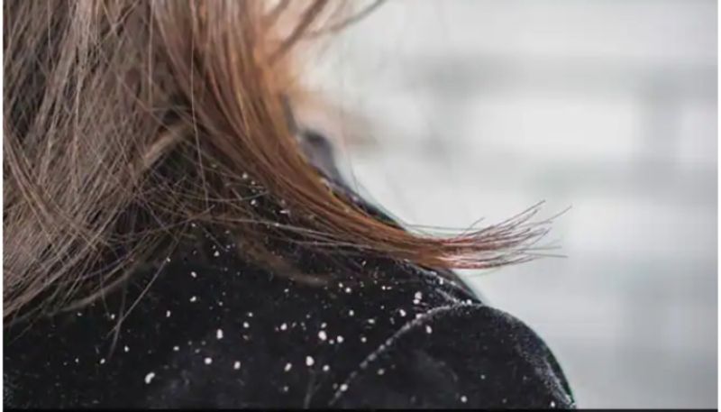 Add These Foods To Your Diet To Fight Dandruff In The Winter