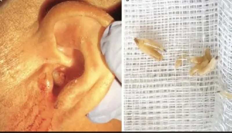 Portugal doctors found flesh eating worms on human eardrum akb