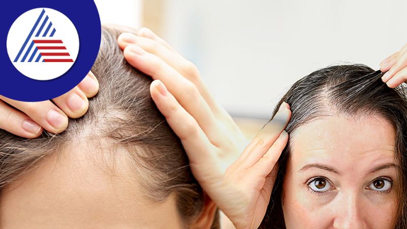 Female Baldness Reason Behind for Hair Fall