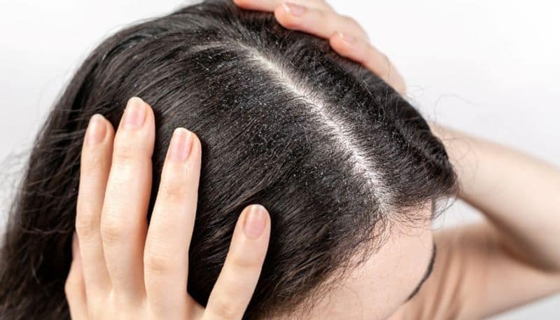 three ingredient Ayurvedic hair mask to get rid of dandruff