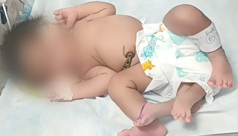 Madhya Pradesh baby girl born with four legs in Gwalior akb