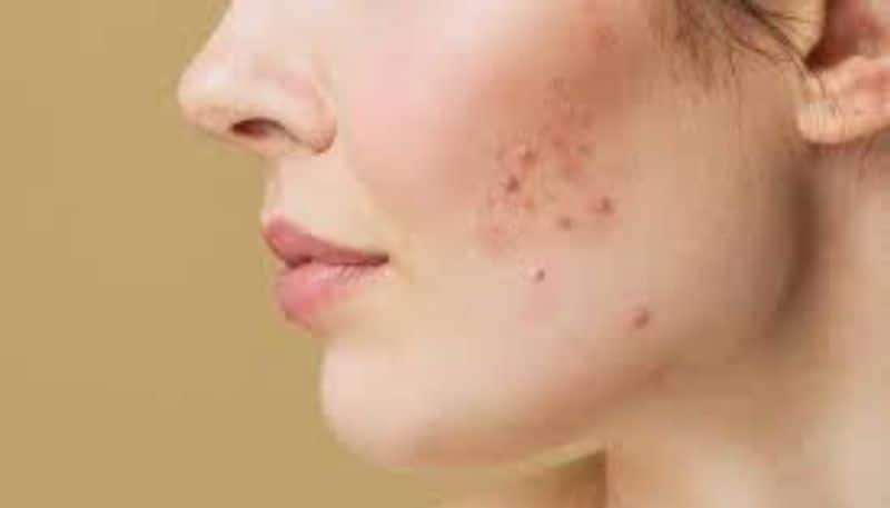 acne and hair fall may be the sign of polycystic ovary syndrome