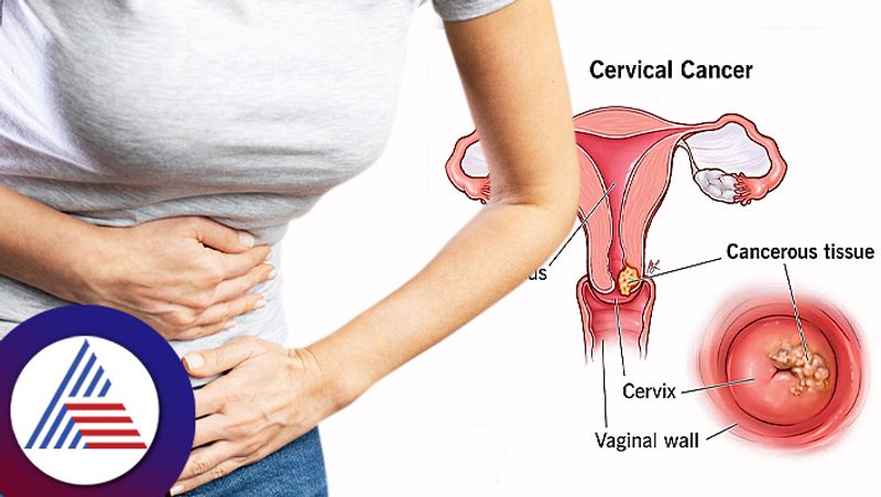 Woman dies of cervical cancer.. What are its symptoms? How to prevent disease? Rya