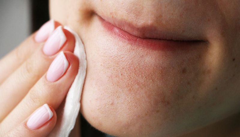 How To Get Rid of Blackheads Naturally