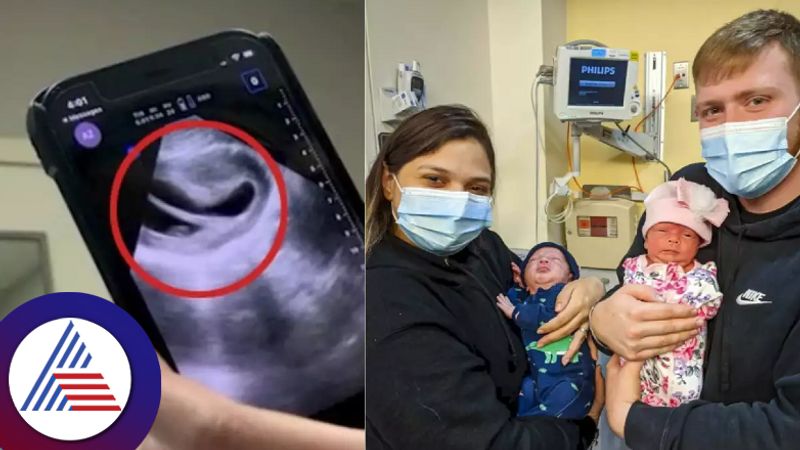 Woman with heart shaped uterus gives birth to one in 500-million twins Vin