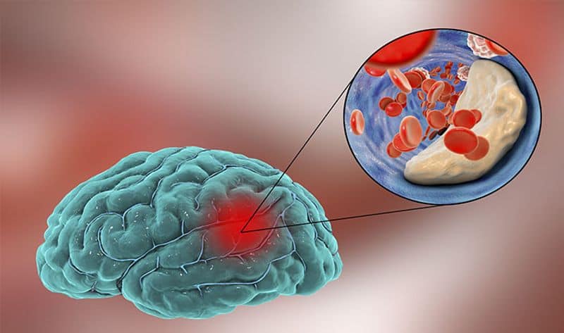 new study on Nasal Drops Treatment for Stroke