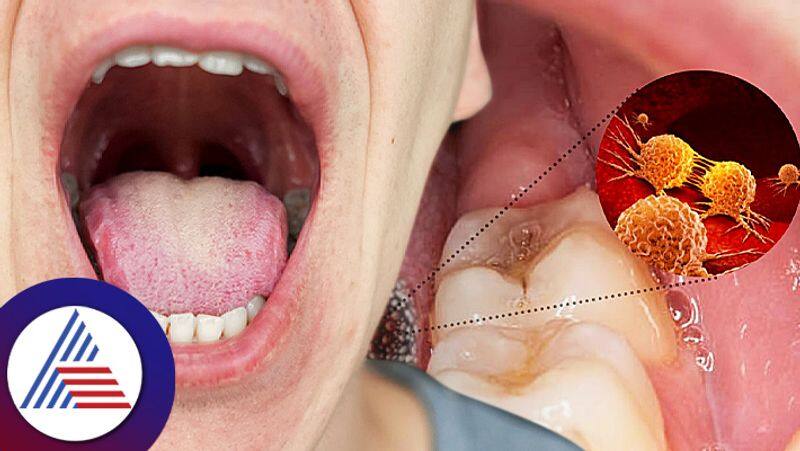 These are the early symptoms of mouth cancer which looks like a bad oral hygiene