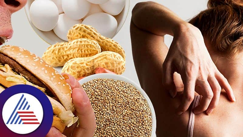 These are the food items not to eat if you have Eczema